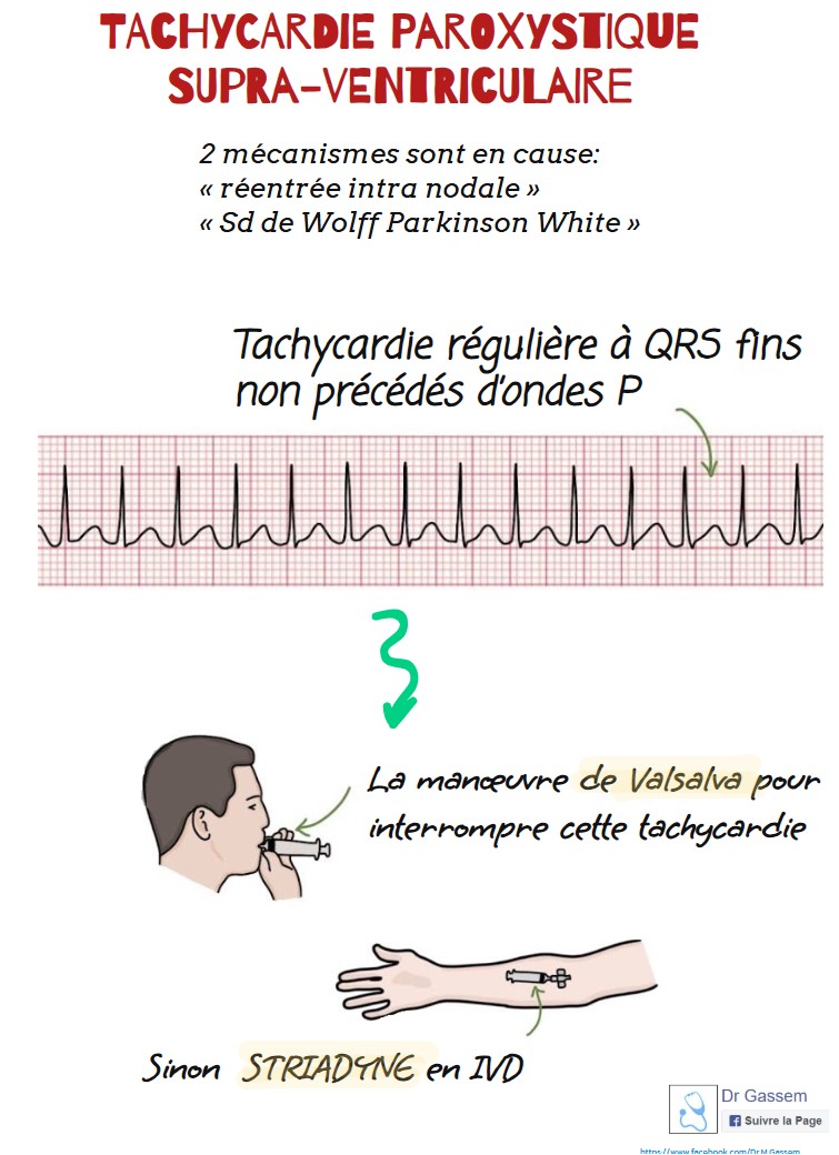 Tachycardie paroxystique supra ventriculaire